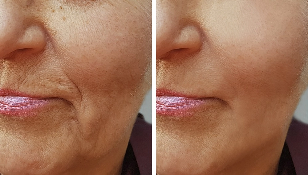 Botox
